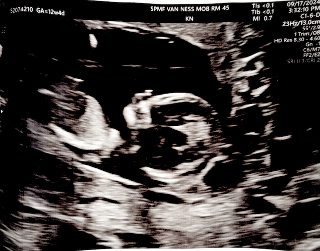 File:Foetal Ultrasound - 12 w.png