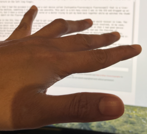 A photograph of my hand with a bent ring finger